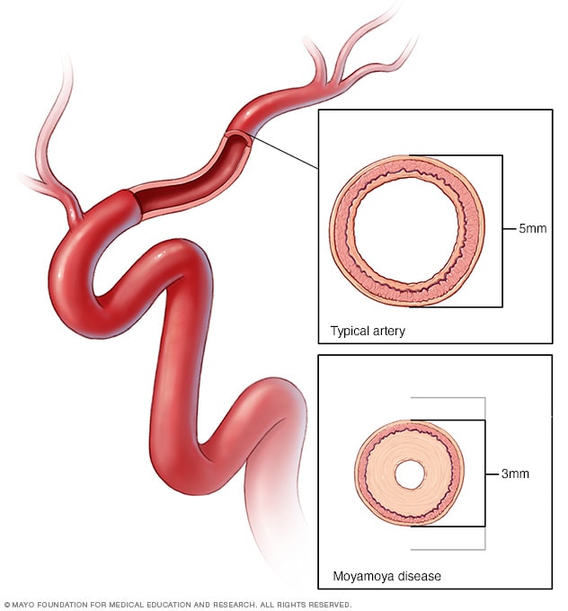 Moyamoya disease