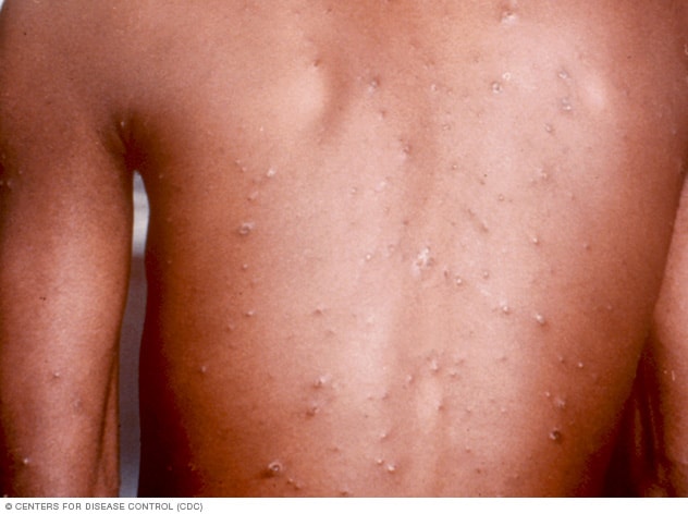 Chickenpox on darker skin