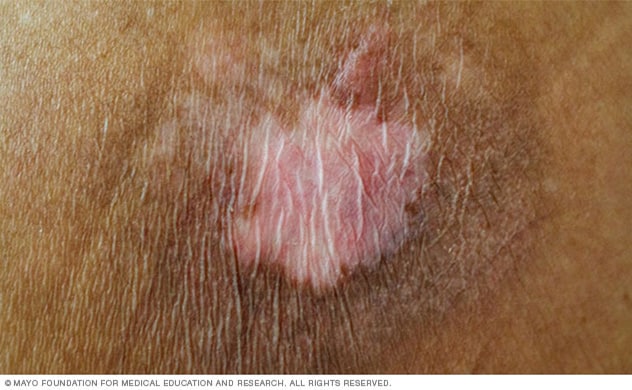Changes in skin color or texture can be a warning sign of a bedsore.