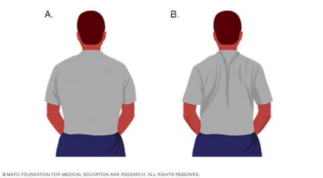 Sleeping positions that reduce back pain - Mayo Clinic