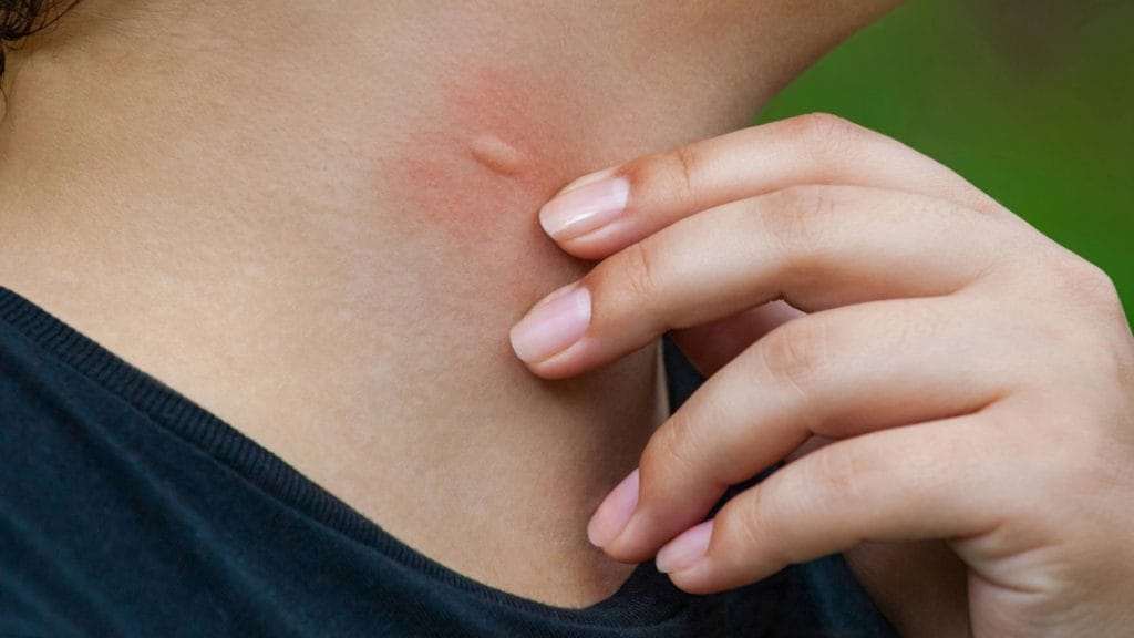 Children Mosquito Bites on the Legs Stock Image - Image of bite, infant: 4897614