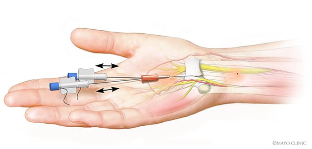 The thread carpal tunnel release procedure