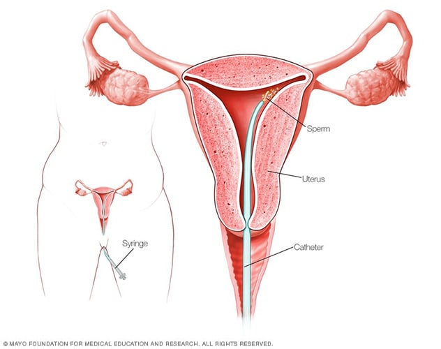 كيفية إجراء الإخصاب داخل الرحم