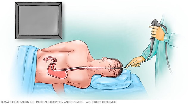 Endoscopia superior