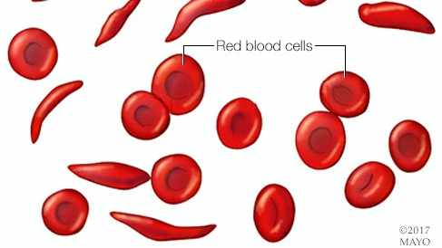 sickle cell anemia medical report