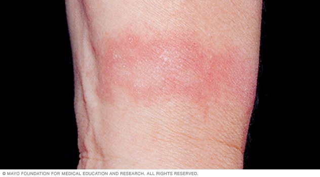 Irritant contact dermatitis likely due to soap residue trapped tightly against the skin