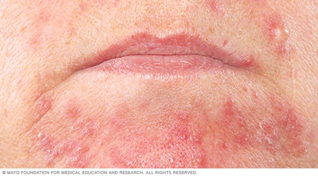 Dermatitis perioral