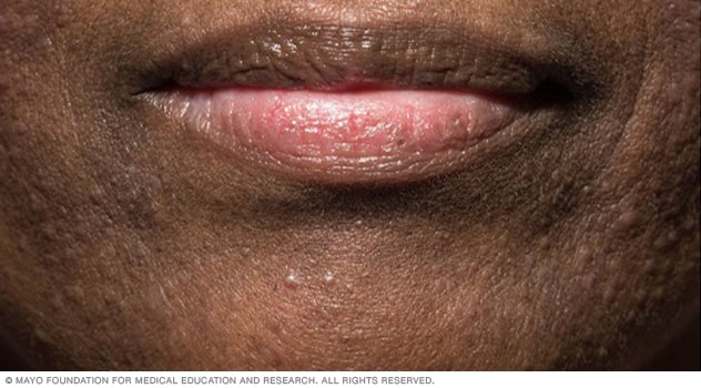 Perioral dermatitis