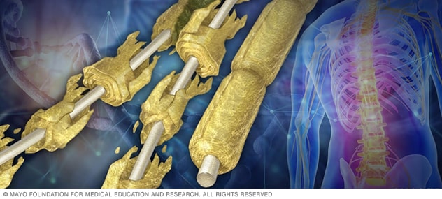 Damaged and undamaged nerves beside a transparent illustration of the body that highlights the central nervous system.