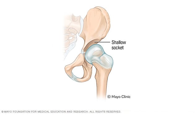 Illustration of a shallow hip socket joint.