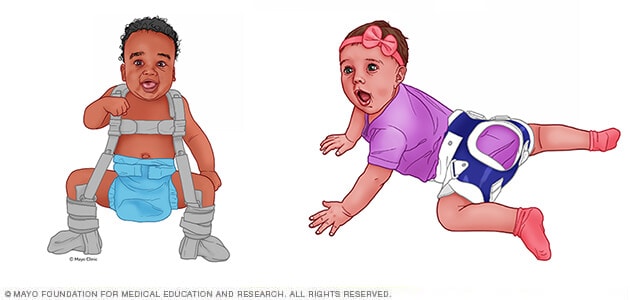 A Pavlik harness and an abduction brace illustrated on infants side by side.