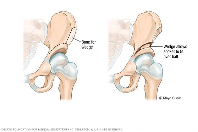 Illustration of a Pemberton osteotomy.