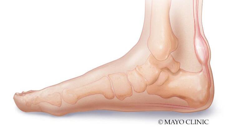 Achilles tendon strain treatment on sale