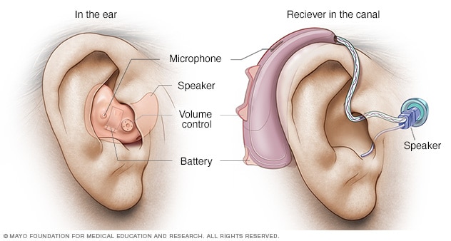 Hearing aid with common parts labeled