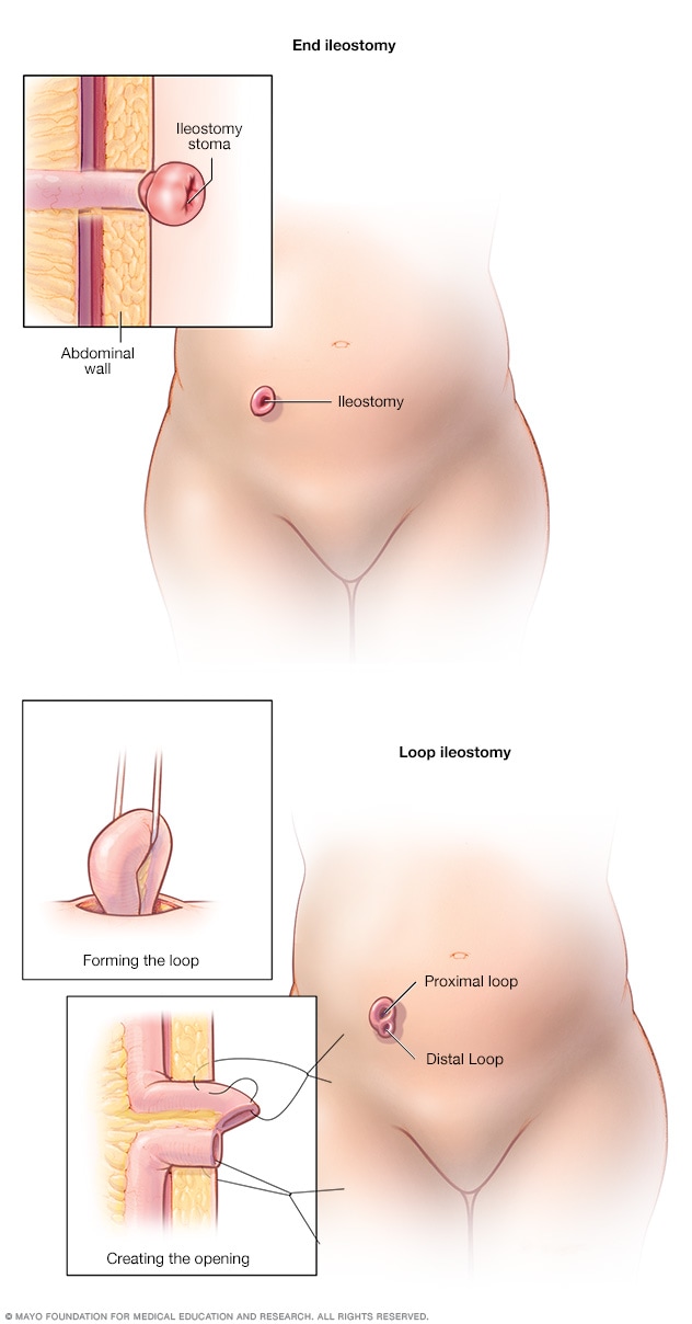 End ileostomy and loop ileostomy
