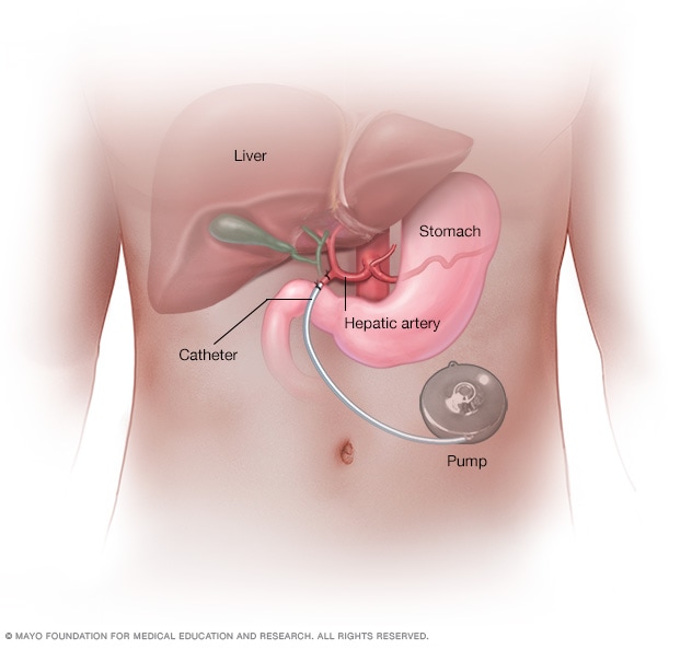 A hepatic artery infusion pump is connected by a catheter to the hepatic artery to deliver chemotherapy to cancer in the liver.