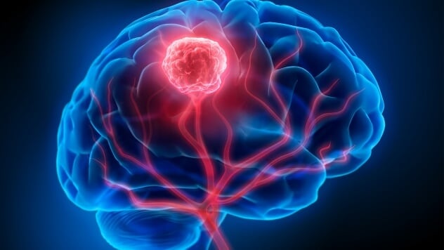 Visualization image of a brain tumor