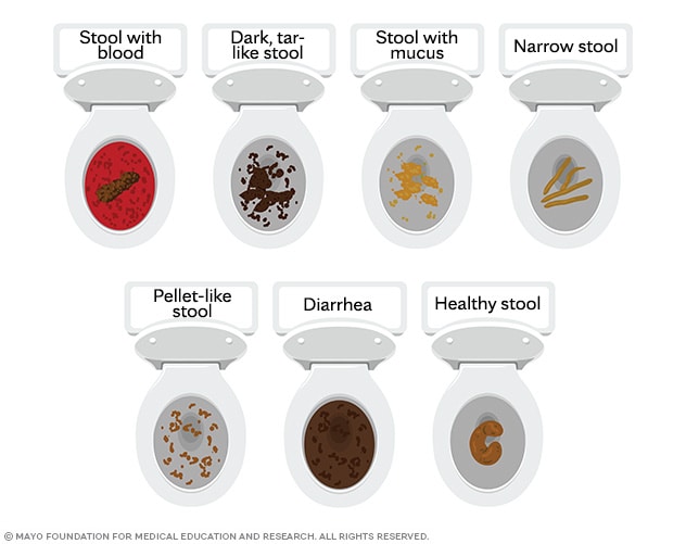 Various types of stools that may be associated with colon cancer, including stools with visible red blood, black tarry stool, stool with mucus, narrow ribbonlike stool, pelletlike stool, diarrhea and healthy stool