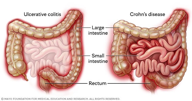 A diagram of the intestines showing the different areas affected by ulcerative colitis and Crohn's disease.