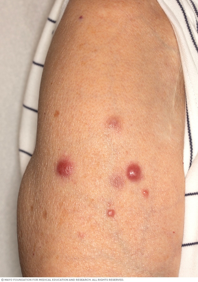 Cutaneous B-cell lymphoma showing up as a group of red bumps on the arm
