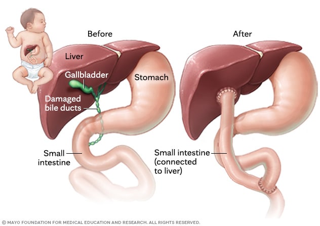 A baby's anatomy before and after the Kasai procedure
