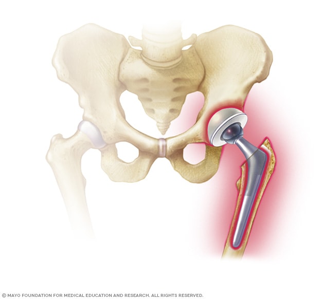 Infected prosthetic hip joint
