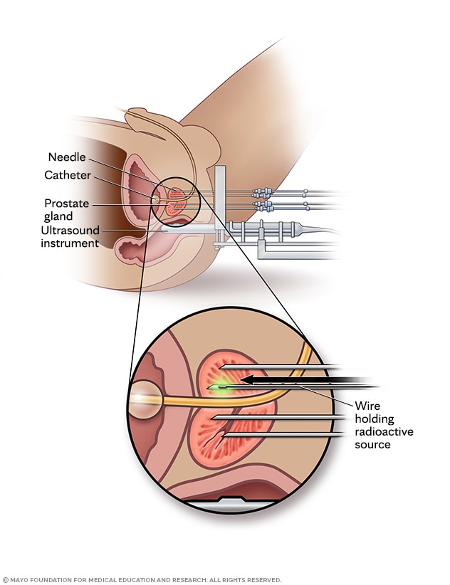 Needle delivering radioactive source into the prostate