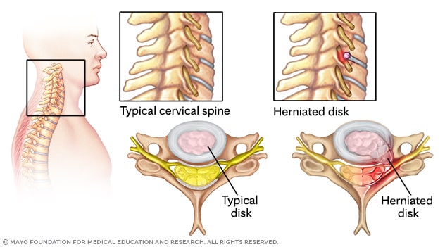 Herniated disk in the cervical spine