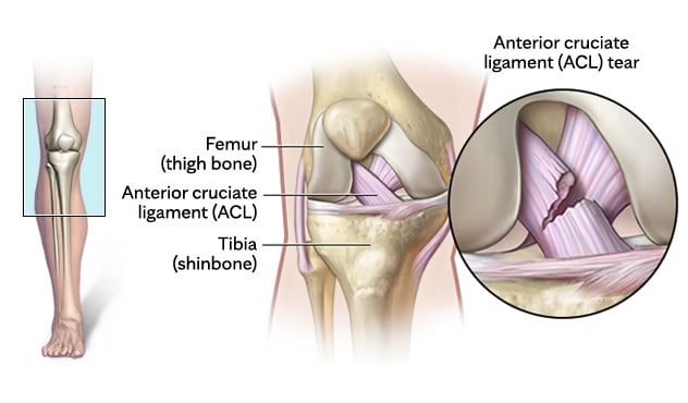Anterior cruciate ligament