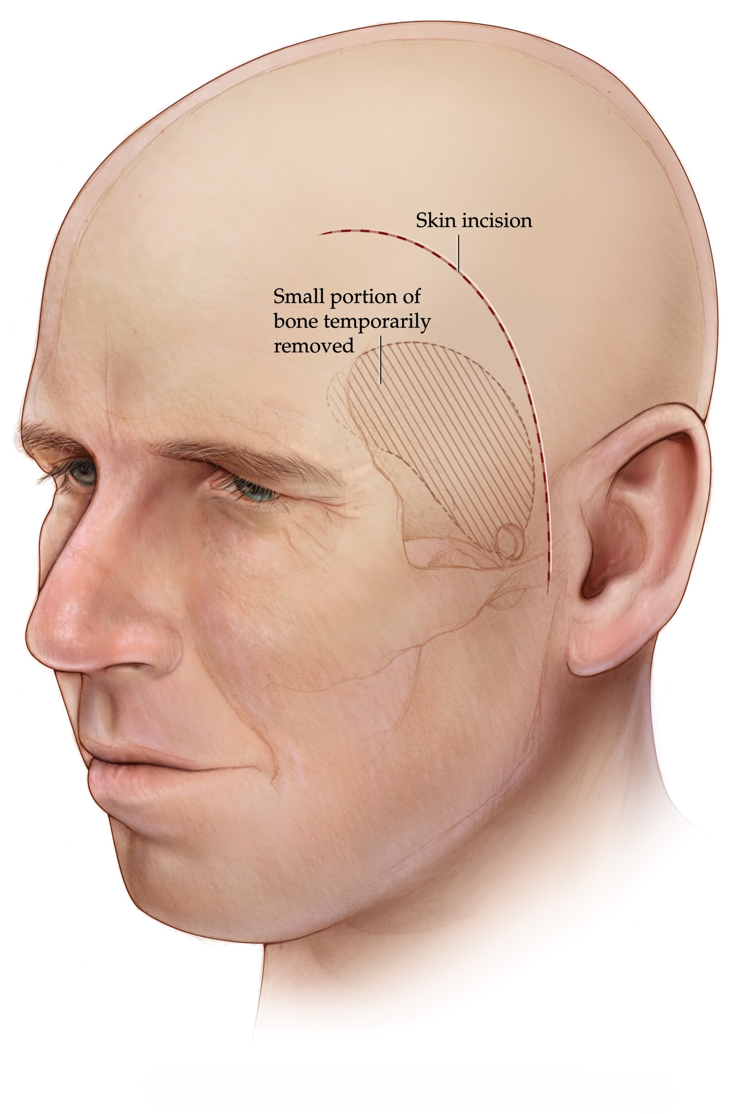 Illustration of a planned skin incision and small area for bone removal during a pterional craniotomy.