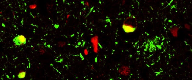 Microscopy image of a cell inclusion double-stained using tau (green) and TDP-43 (red)