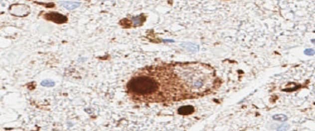 Microscope slide showing Lewy body dementia in human brain tissue.