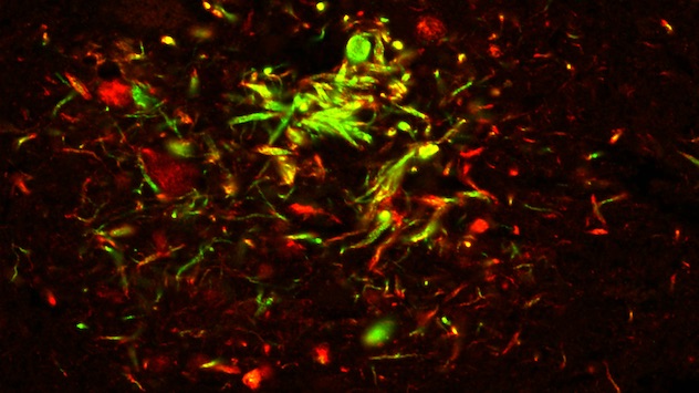 Microscopy showing amyloid plaque in a patient with Alzheimer's disease
