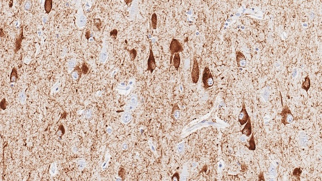 Microscopy showing neurofibrillary tangles in a patient with Alzheimer's disease