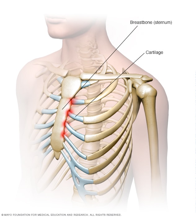 التهاب الغضروف الضلعي الأعراض والأسباب mayo clinic مايو كلينك