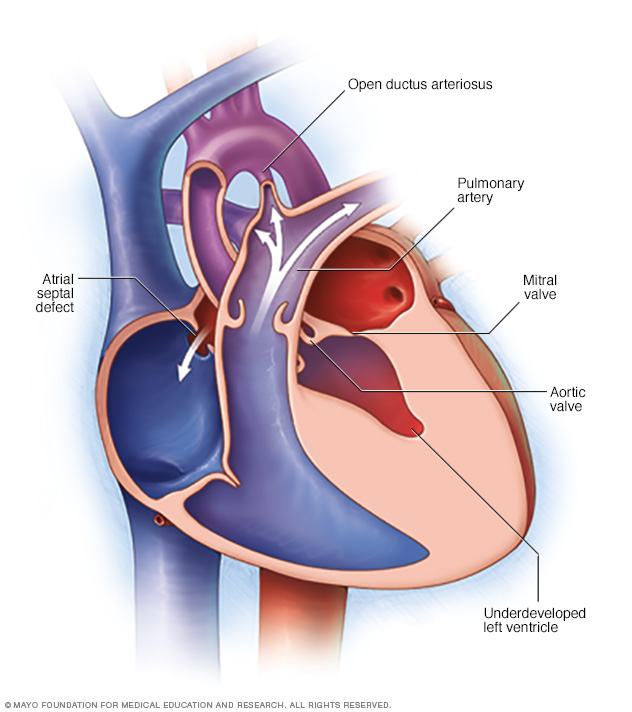 متلازمة القلب الأيسر ناقص التنسج الأعراض والأسباب Mayo Clinic مايو كلينك