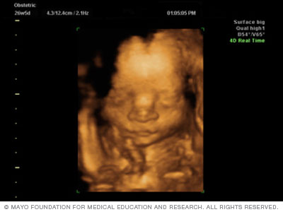 شريحة تعرض تصوير ثلاثي الأبعاد بالموجات فوق الصوتية يظهر وجه الجنين
