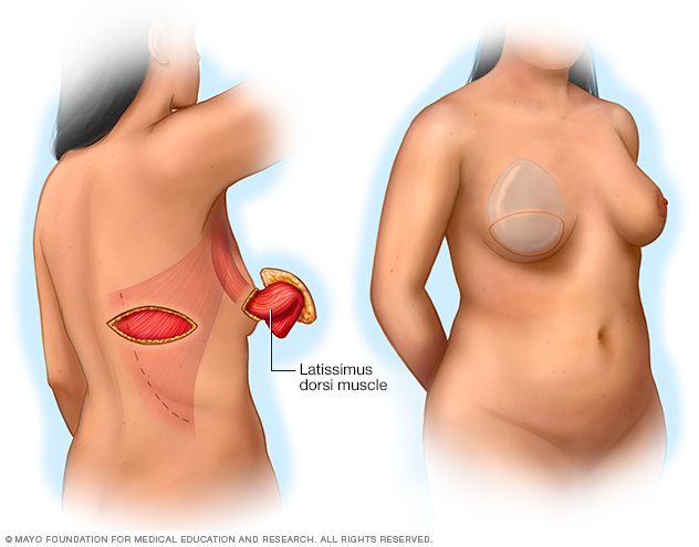 رسم توضيحي يظهر إجراء شريحة للعضلة الظهرية العريضة للسديلة العنيقية 