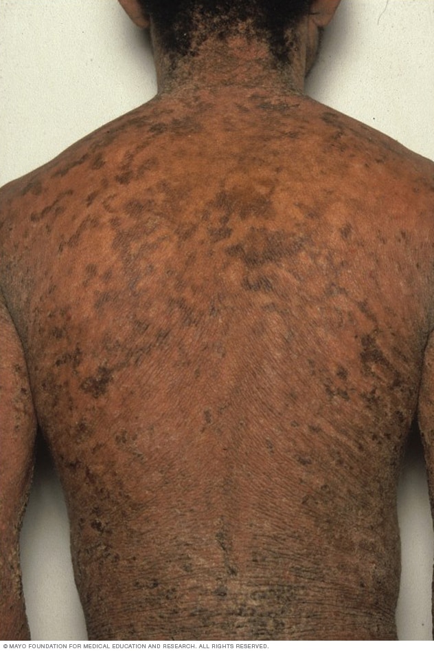 س ماك شائ ع الأعراض والأسباب mayo clinic مايو كلينك