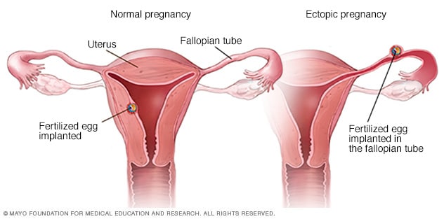الحمل الطبيعي مقابل الحمل خارج الرحم