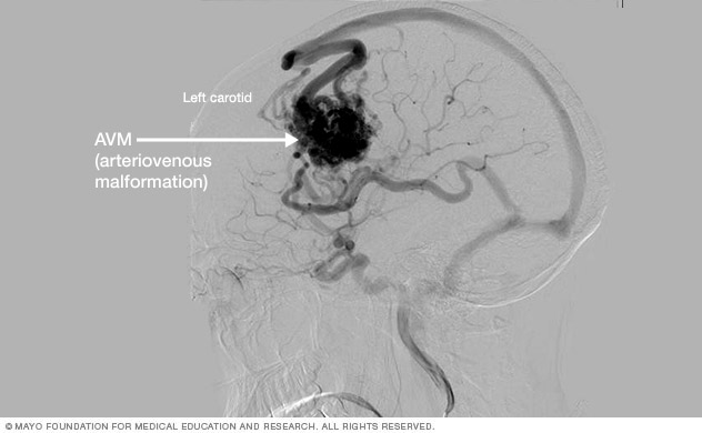 صورة وعائية للتشوه الشرياني الوريدي (AVM) في الدماغ