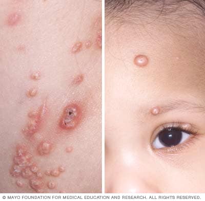المليساء المعدية الأعراض والأسباب mayo clinic مايو كلينك