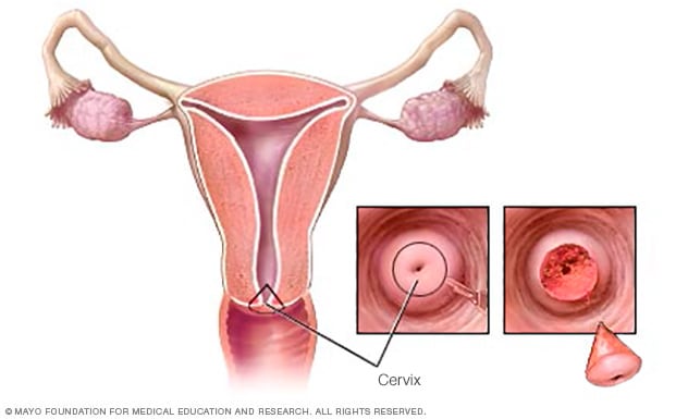 سرطان عنق الرحم التشخيص والعلاج mayo clinic مايو كلينك