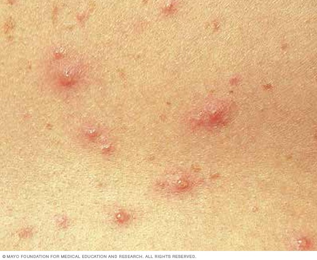 جدري الماء الأعراض والأسباب mayo clinic مايو كلينك