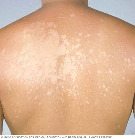 السعفة المبرقشة الأعراض والأسباب mayo clinic مايو كلينك السعفة المبرقشة الأعراض والأسباب mayo clinic مايو كلينك
