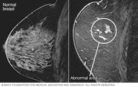 صور لتصوير الثدي بالرنين المغناطيسي