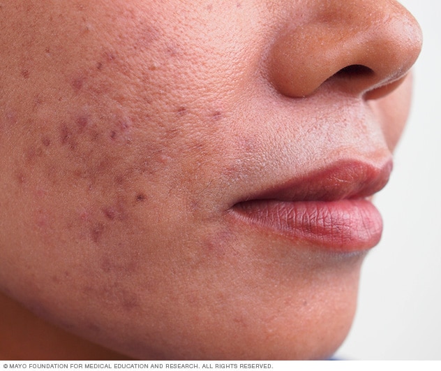 حب الشباب الأعراض والأسباب mayo clinic مايو كلينك
