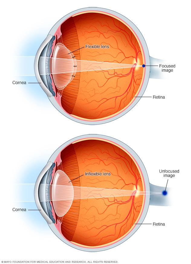 مقل العين مع نقطة تركيز دون قُصُوّ البصر الشيخوخي (الأعلى) ومع قُصُوّ البصر الشيخوخي (الأسفل)