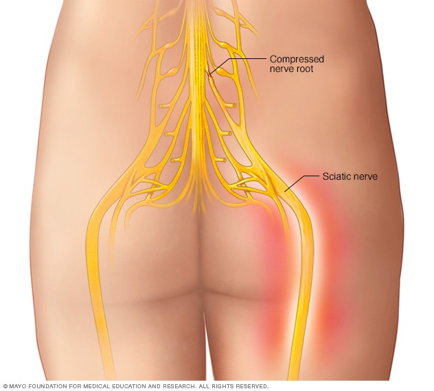 عرق النسا الأعراض والأسباب Mayo Clinic مايو كلينك