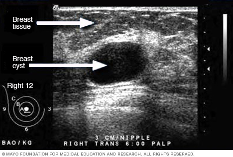 الموجات فوق الصوتية Mayo Clinic مايو كلينك
